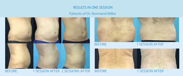 CoolSculpting® Before and After
