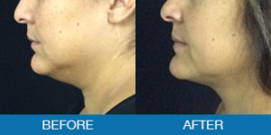 PrecisionTX™ Before and After - New Hampshire, Dr. Miller