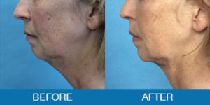 PrecisionTX™ Before and After - New Hampshire, Dr. Miller