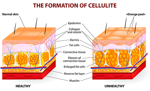 The Formation of Cellulite