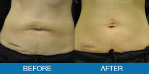 Cellulite Treatment Before and After - New Hampshire, Dr. Miller