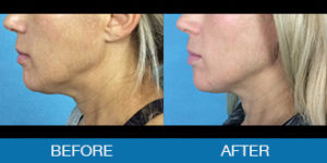 Exilis™ Before and After - New Hampshire, Dr. Miller
