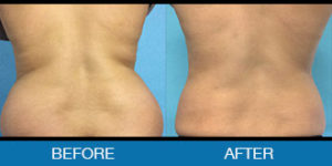 Smartlipo® Before and After - New Hampshire, Dr. Miller
