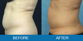 Smartlipo® Before & After Photos