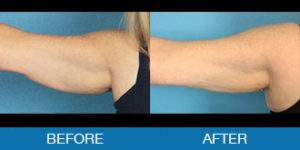 Exilis™ Before and After - New Hampshire, Dr. Miller