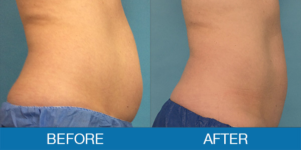 CoolSculpting® Before & After Photos