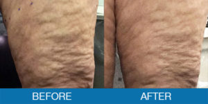 Cellulite Treatment Before and After - New Hampshire, Dr. Miller