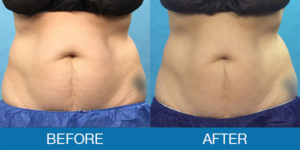 CoolSculpting® Before and After - New Hampshire, Dr. Miller