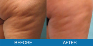 Cellulaze® Before and After - New Hampshire, Dr. Miller