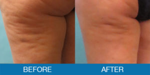 Cellulaze® Before and After - New Hampshire, Dr. Miller