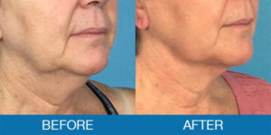 PrecisionTX® Before and After - New Hampshire, Dr. Miller