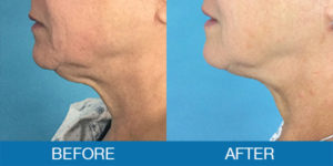 PrecisionTX® Before and After - New Hampshire, Dr. Miller