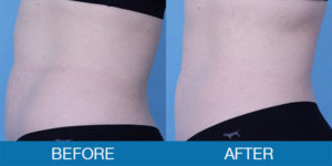 CoolTone® Before and After - New Hampshire, Dr. Miller