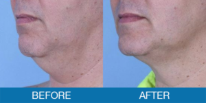 CoolSculpting® Before and After - New Hampshire, Dr. Miller