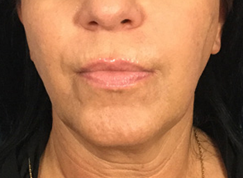 Closeup of patient with sagging chin before Exilis Ultra Skin Tightening