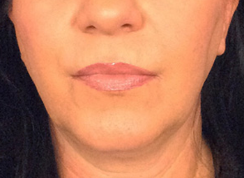 Closeup of patient with tighter chin after Exilis Ultra Skin Tightening