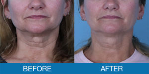 Exilis Ultra™ Before and After - New Hampshire, Dr. Miller