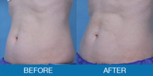 Exilis Ultra™ Before and After - New Hampshire, Dr. Miller