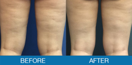 Cellulite Treatment Gallery
