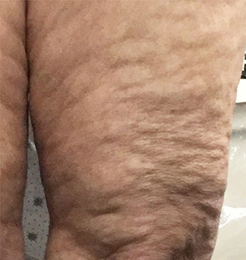 Cellulite Treatment After - Salem, NH - Nashua, NH