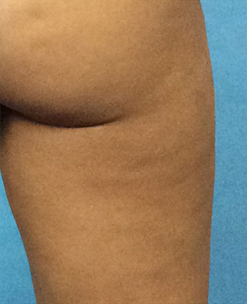 Cellulite Treatment After - Salem, NH - Nashua, NH