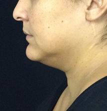 Closeup of patient with sagging chin before PrecisionTx® Skin Tightening