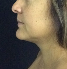 Closeup of patient with tighter chin after PrecisionTx® Skin Tightening