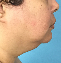 Closeup of patient with sagging chin before PrecisionTx® Skin Tightening