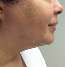Closeup of patient with tighter chin after PrecisionTx® Skin Tightening