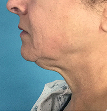 Closeup of patient with sagging chin before PrecisionTx® skin tightening