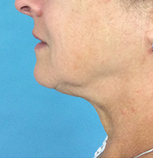 Closeup of patient with tighter chin after PrecisionTx® skin tightening